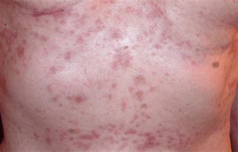 Inflammatory breast cancer rash. . Itchy breast rash pictures